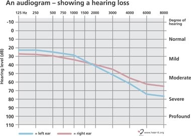 شنوایی سنجی کودکان چگونه است؟