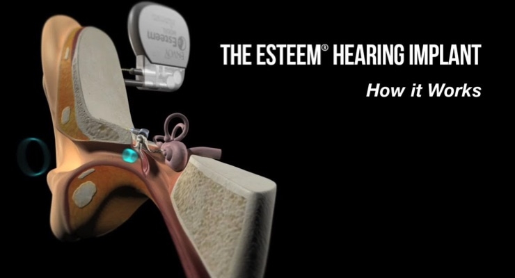 شمای کلی سمعک کاملا کاشتنی esteem